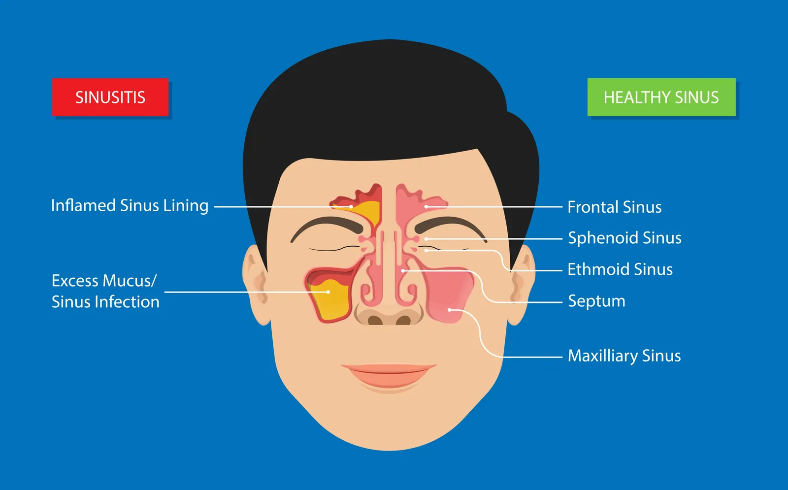 sinusitis