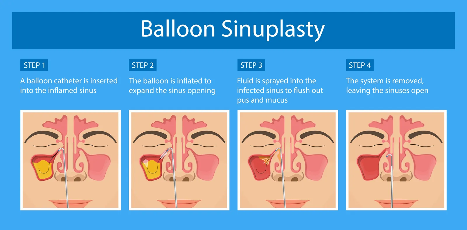 Four-step illustration of balloon sinus dilation: the catheter is inserted, the balloon is inflated to widen the sinus opening, the sinus is flushed, and the system is removed