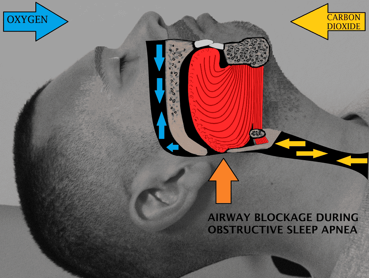 Obstructive Sleep Apnea