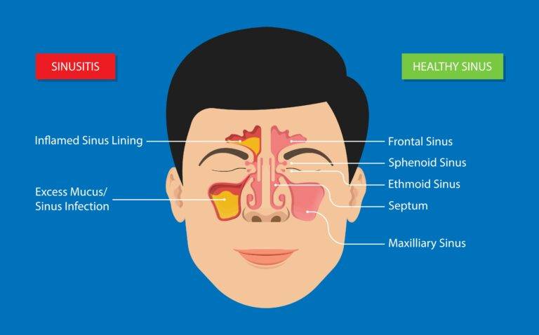 What is Balloon Sinuplasty: A Comprehensive Guide - LA Sinus and Snoring